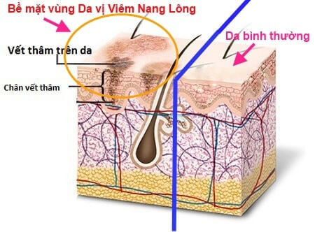 trị viêm nang lông ở chân trị viêm nang lông ở chân