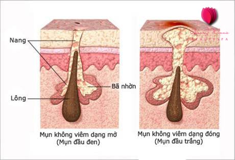 cách trị mụn đầu đen cách trị mụn đầu đen