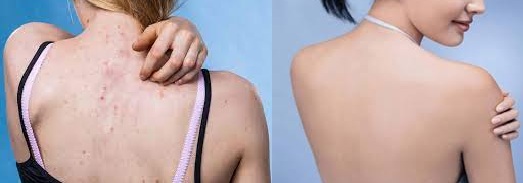 xà phòng tri mụn lưng xà phòng tri mụn lưng