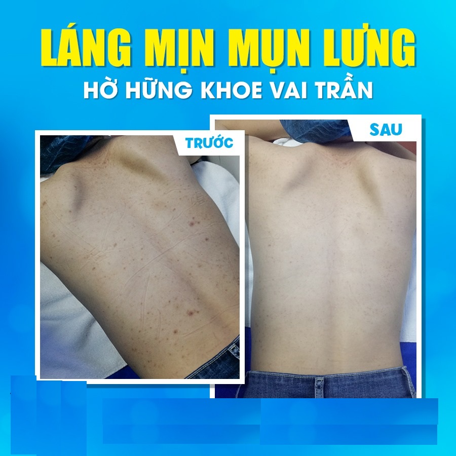 viêm nang lông có tự hết không viêm nang lông có tự hết không