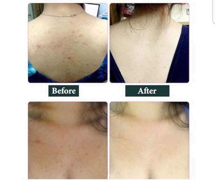 xà phòng trị mụn body xà phòng trị mụn body