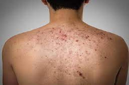 mụn lưng nam giới mụn lưng nam giới
