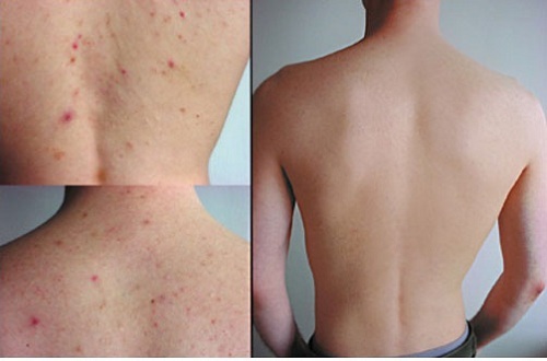 mụn lưng nam mụn lưng nam
