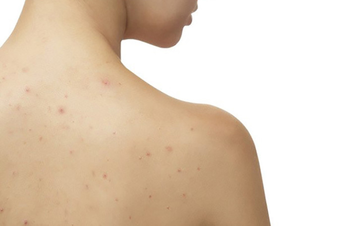 xà bông trị mụn lưng xà bông trị mụn lưng