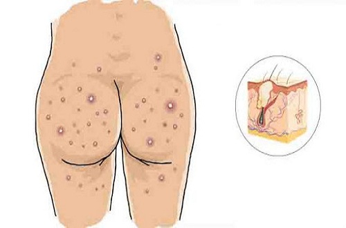 mụn ở mông mụn ở mông