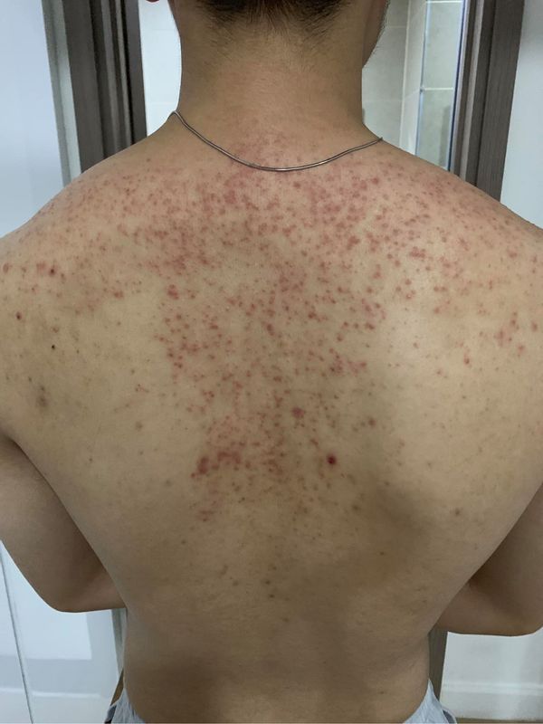 xà bông trị mụn lưng xà bông trị mụn lưng