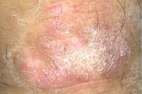 chàm bìu chàm bìu