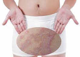 chàm bìu chàm bìu