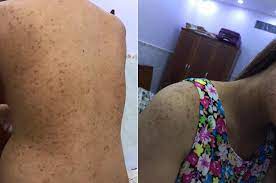 xà bông trị mụn lưng xà bông trị mụn lưng