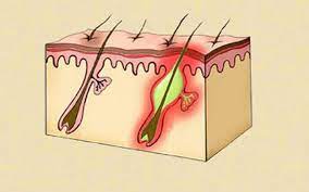 xà phòng trị mụn lưng ngực xà phòng trị mụn lưng ngực