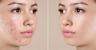 xà bông trị mụn xà bông trị mụn