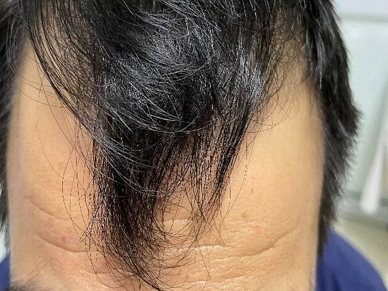 Chữa Rụng Tóc Hiệu Quả Với Dầu Dừa Tự Nhiên.