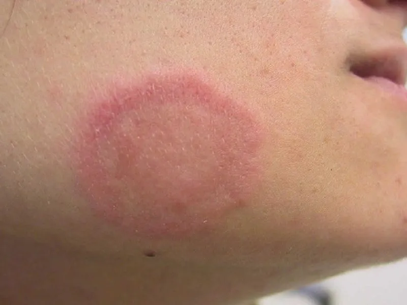  Xà Bông Dừa - Giải Pháp Tự Nhiên Cho Làn Da Bị Nấm