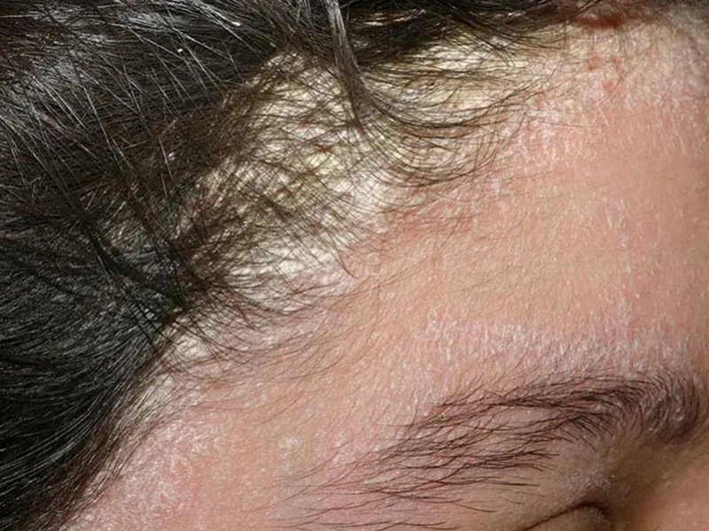 Nấm Da Đầu: Nguyên Nhân, Biểu Hiện Và Cách Điều Trị Hiệu Quả