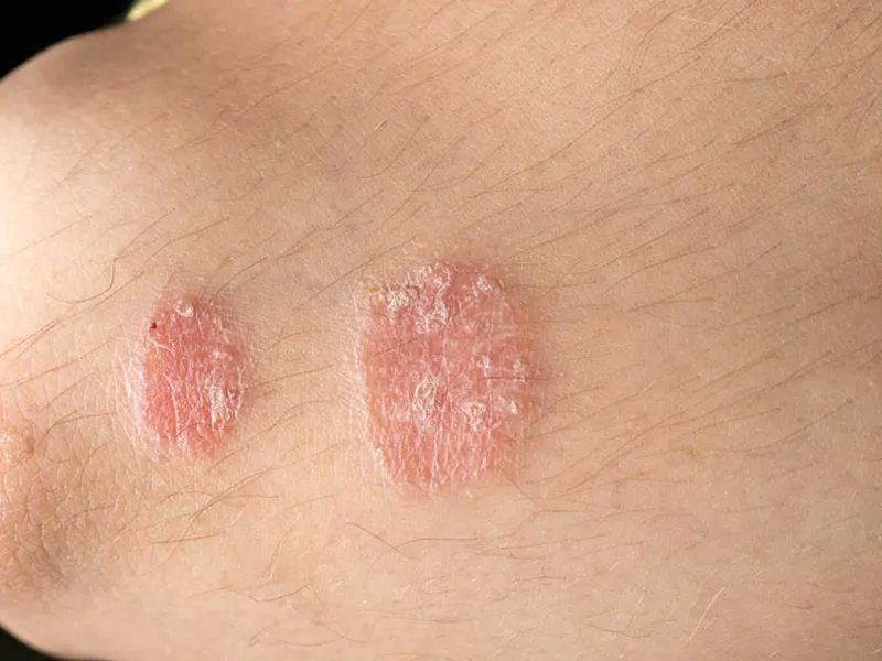 Khám Phá Ưu Điểm Của Dầu Dừa Trong Điều Trị Nấm Da