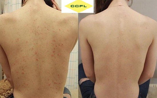 xà bông trị mụn lưng xà bông trị mụn lưng