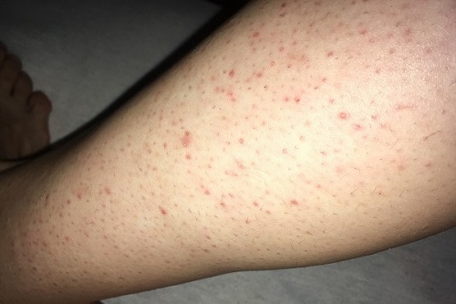 trị viêm nang lông ở chân trị viêm nang lông ở chân