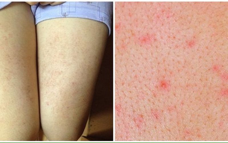 trị viêm nang lông tại nhà trị viêm nang lông tại nhà