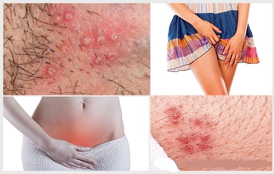 cách trị viêm nang lông vùng kín cách trị viêm nang lông vùng kín