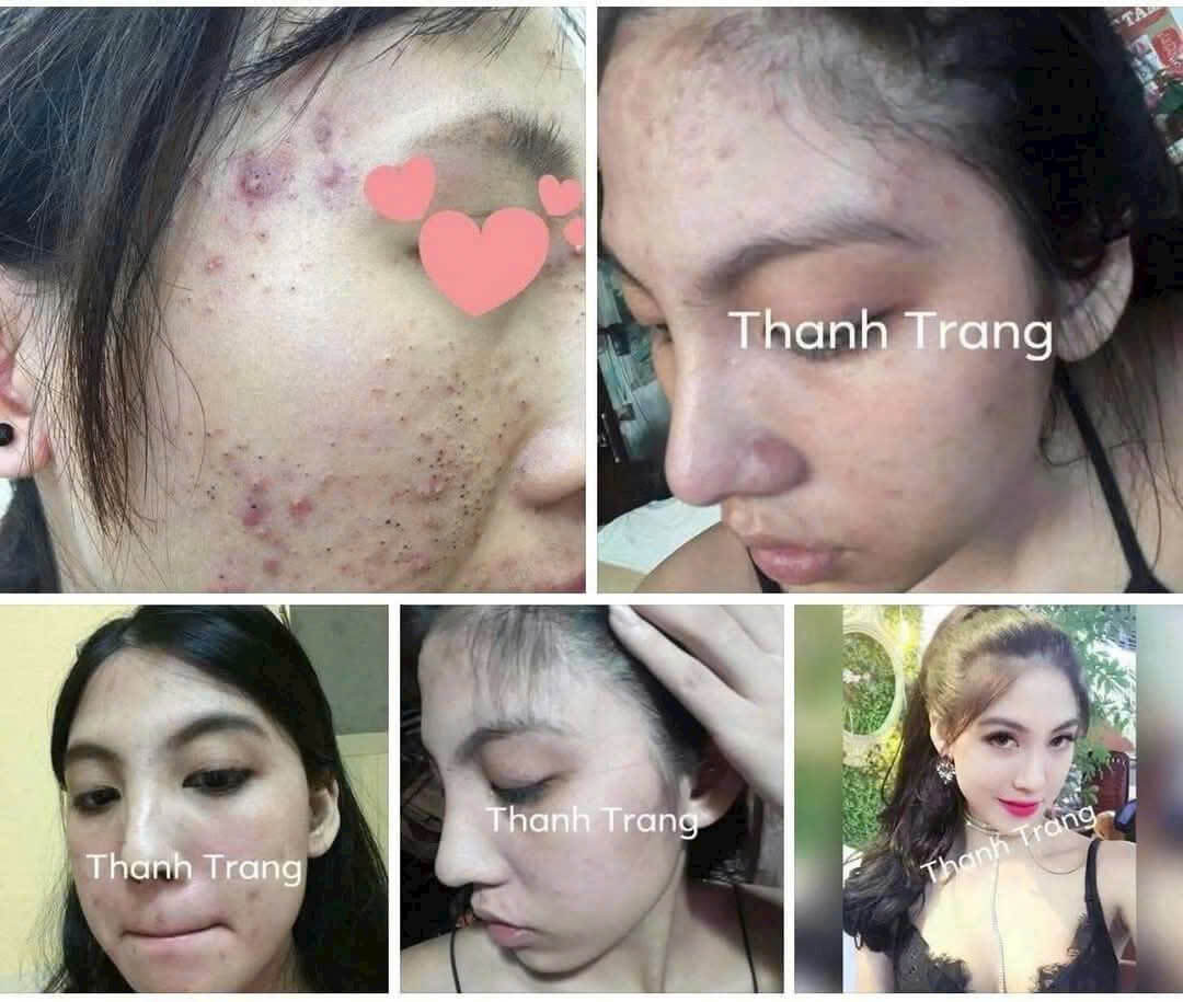 Giai đoạn 1: Da đẩy mụn và bong nhẹ (1–3 tuần đầu) Da có thể đỏ, bong nhẹ và mụn nổi lên là hiện tượng bình thường.