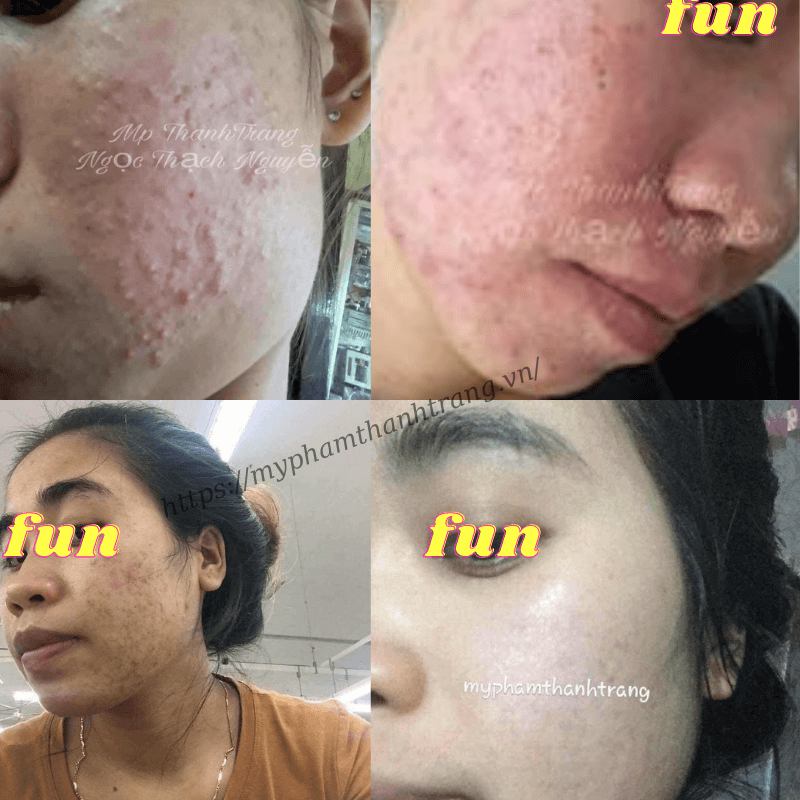 Mỹ phẩm Thanh Trang sau khi tái tạo da xong có tái phát lại không Mỹ phẩm Thanh Trang sau khi tái tạo da xong có tái phát lại không