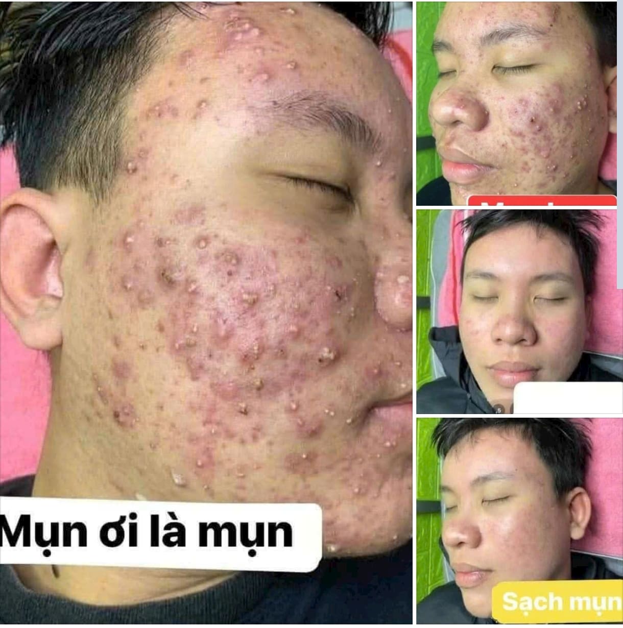 Linh Chi Vi Mụn - Sản phẩm chủ lực trong liệu trình tái tạo da Thanh Trang Khách hàng sử dụng liệu trình tái tạo da Thanh Trang với Linh Chi Vi Mụn để cải thiện tình trạng mụn.