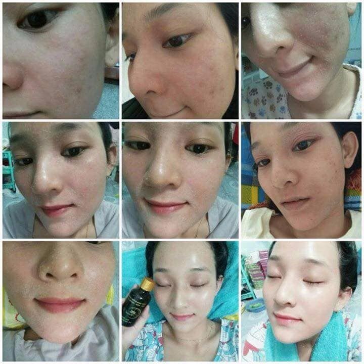 Tư vấn trị mụn: Có nên mua thuốc trị mụn Thanh Trang? Tư vấn trị mụn: Có nên mua thuốc trị mụn Thanh Trang?