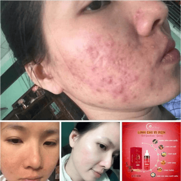 Tái tạo da phù hợp với da yếu, da nhạy cảm, da mụn thâm – nám tái phát, da phục hồi chậm. Nếu da bạn đang “mệt”, dễ kích ứng, thì chăm sóc da bền vững là lựa chọn an toàn và lâu dài. Không phải ai cũng cần tái tạo da