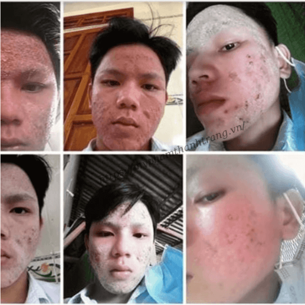 Da yếu không đến từ việc bạn “chăm chưa đủ”, mà thường đến từ việc da phải chịu quá nhiều tác động cùng lúc. Khi active mạnh, treatment dày và thay đổi sản phẩm liên tục, da không kịp phục hồi và dần mất khả năng tự bảo vệ. Vì sao da ngày càng yếu dù chăm rất kỹ?