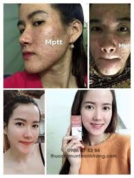 Tại sao cần sử dụng đầy đủ combo trị mụn Thanh Trang? Tại sao cần sử dụng đầy đủ combo trị mụn Thanh Trang?