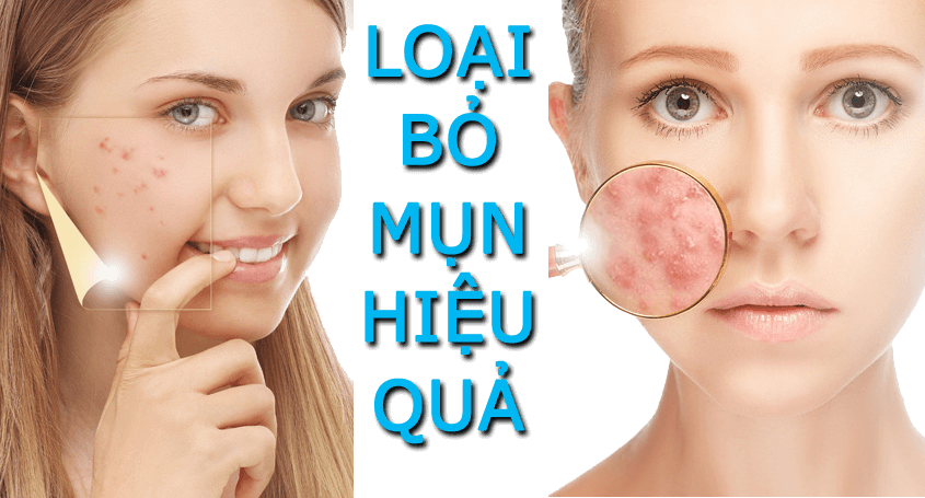 Giải mã “cơn sốt” trị mụn đến từ thảo dược trị mụn Thanh Trang Giải mã “cơn sốt” trị mụn đến từ thảo dược trị mụn Thanh Trang