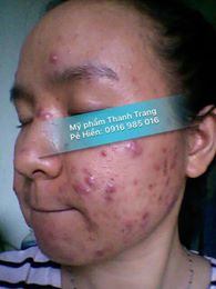 Chị Diệu Tái Tạo Da Thành Công Bằng Thảo Dược Trị Mụn Thanh Trang Chị Diệu Tái Tạo Da Thành Công Bằng Thảo Dược Trị Mụn Thanh Trang