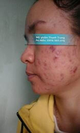 Chị Diệu Tái Tạo Da Thành Công Bằng Thảo Dược Trị Mụn Thanh Trang Chị Diệu Tái Tạo Da Thành Công Bằng Thảo Dược Trị Mụn Thanh Trang