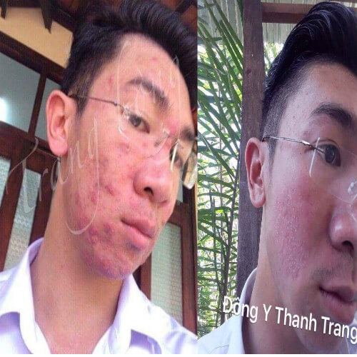 Dung dịch mụn nám Thanh Trang có tốt không? Dung dịch mụn nám Thanh Trang có tốt không?