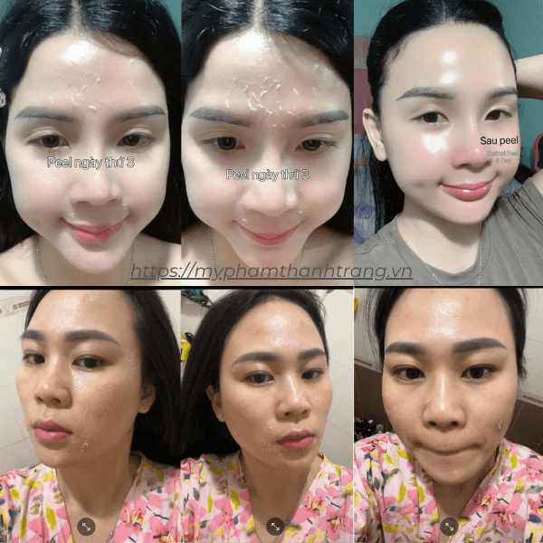 Khách Hàng Sử Dụng Retinol Peel Da 3 Day Chanpou - Mỹ Phẩm Thanh Trang Khách Hàng Sử Dụng Retinol Peel Da 3 Day Chanpou - Mỹ Phẩm Thanh Trang