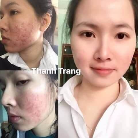 Combo trị mụn Thanh Trang: Dùng như thế nào hiệu quả nhất? Combo trị mụn Thanh Trang: Dùng như thế nào hiệu quả nhất?