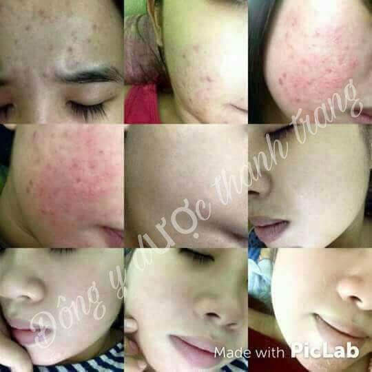 Có nên dùng thuốc đông y trị mụn của mỹ phẩm Thanh Trang? Có nên dùng thuốc đông y trị mụn của mỹ phẩm Thanh Trang?