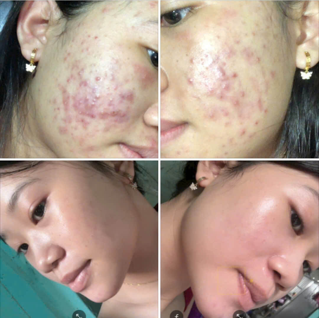 Giai đoạn 3: Da ổn định và mịn màng (6–8 tuần trở đi) Da sáng hơn, đều màu, mịn màng, ít mụn tái phát.”