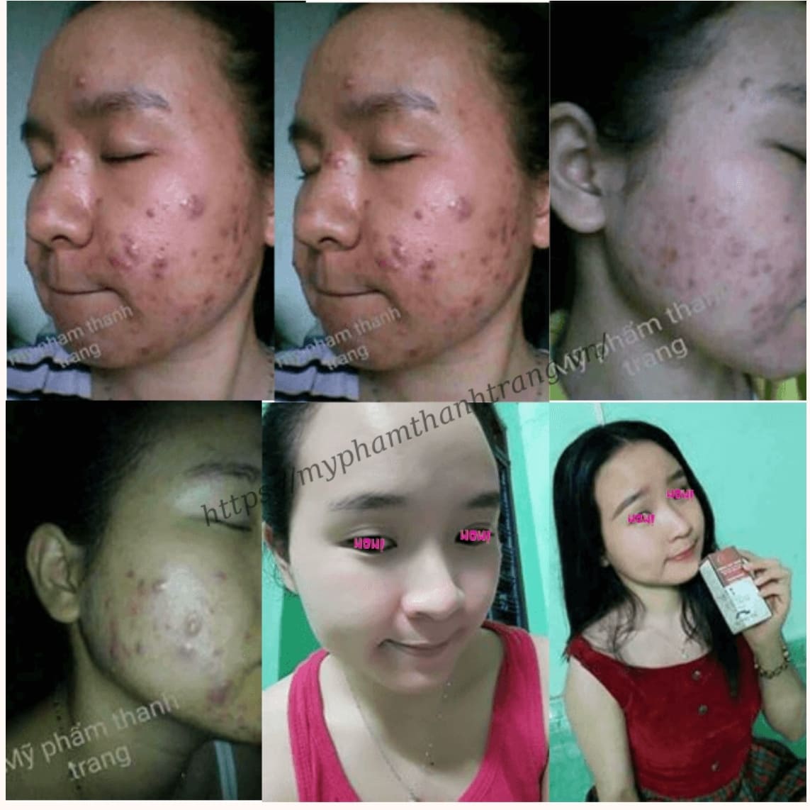 Khách hàng mụn viêm