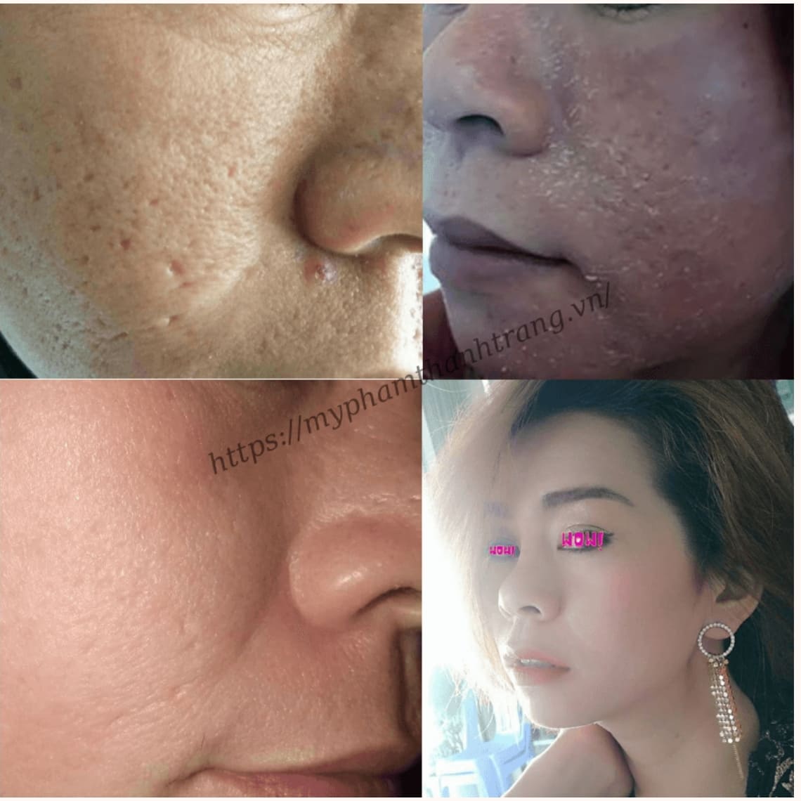 Khách hàng sẹo rỗ