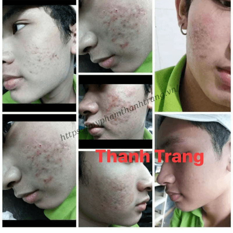 hướng dẫn bạn dùng dung dịch mụn nám Thanh Trang hướng dẫn bạn dùng dung dịch mụn nám Thanh Trang