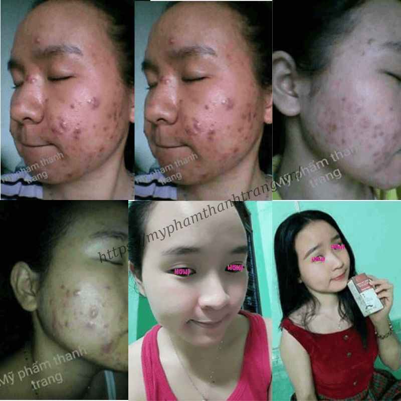 hướng dẫn bạn dùng dung dịch mụn nám Thanh Trang hướng dẫn bạn dùng dung dịch mụn nám Thanh Trang