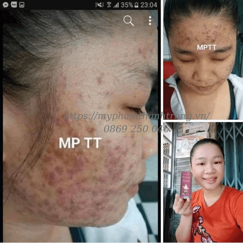 khi nào nên ngưng bôi mỹ phẩm Thanh Trang tái tạo da khi nào nên ngưng bôi mỹ phẩm Thanh Trang tái tạo da