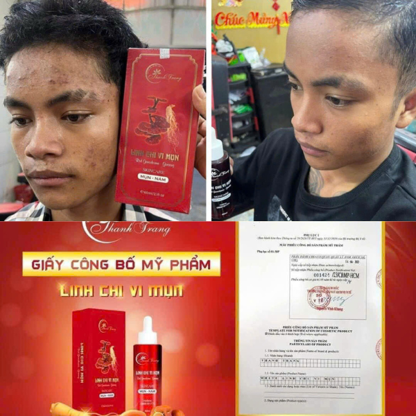 Linh Chi Vi Mụn - Sản phẩm chủ lực trong liệu trình tái tạo da Thanh Trang Hình ảnh thực tế sản phẩm Linh Chi Vi Mụn trong liệu trình tái tạo da Thanh Trang.