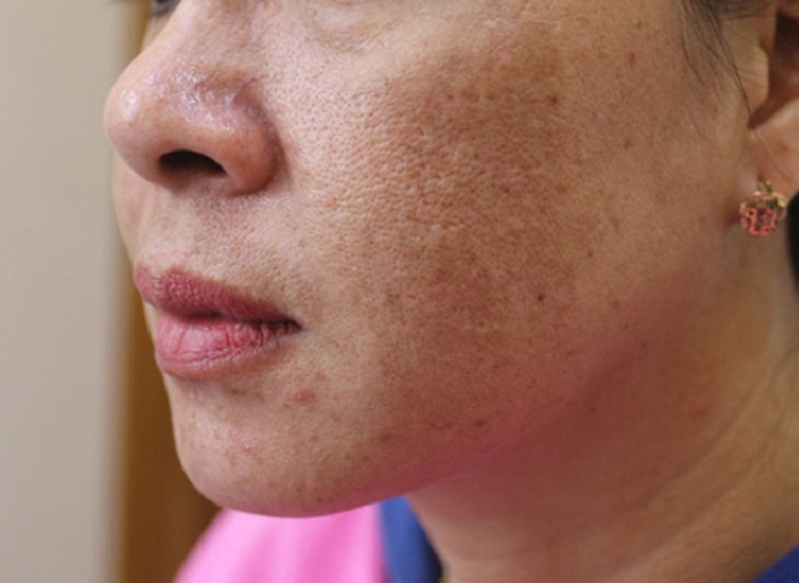 Thuốc đông y trị nám da mặt lâu năm cho phụ nữ tuổi 40+
