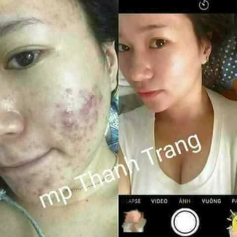 Cách tẩy tế bào chết cho da mặt bị mụn đơn giản mà hiệu quả Cách tẩy tế bào chết cho da mặt bị mụn đơn giản mà hiệu quả