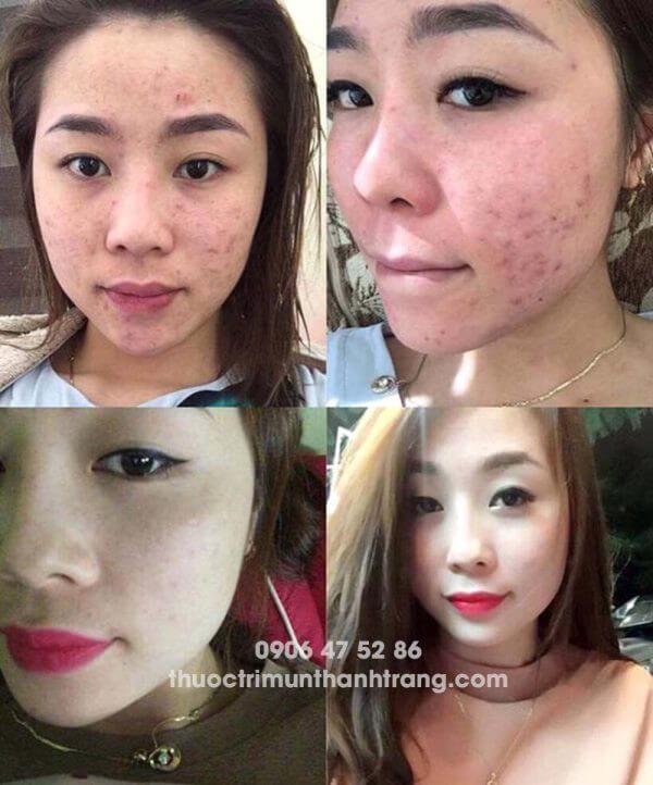 Trị mụn Thanh Trang: “Nhổ tận gốc rễ” các loại mụn trứng cá Trị mụn Thanh Trang: “Nhổ tận gốc rễ” các loại mụn trứng cá