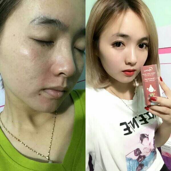 Bí kíp trị mụn tận gốc bằng đông y trị mụn Thanh Trang Bí kíp trị mụn tận gốc bằng đông y trị mụn Thanh Trang