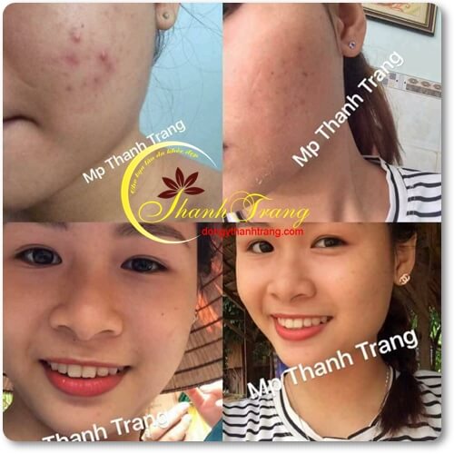 Da nhạy cảm dùng mỹ phẩm Thanh Trang có tốt không? Da nhạy cảm dùng mỹ phẩm Thanh Trang có tốt không?
