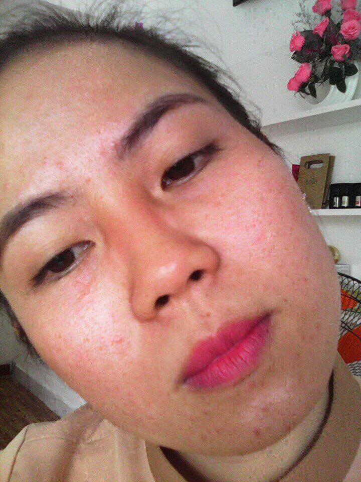 Pé Hiền Tái Tạo Da Bằng Thảo Dược Trị Mụn Thanh Trang Pé Hiền Tái Tạo Da Bằng Thảo Dược Trị Mụn Thanh Trang